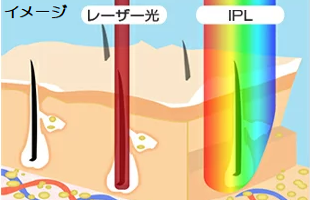 レーザー光とIPL光との比較画像